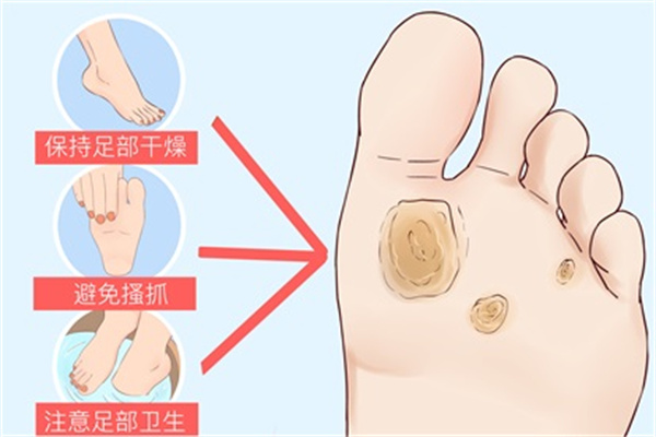 雞眼怎么形成