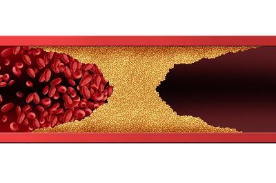 血管堵了自己有感覺嗎 血液病的三大預警信號