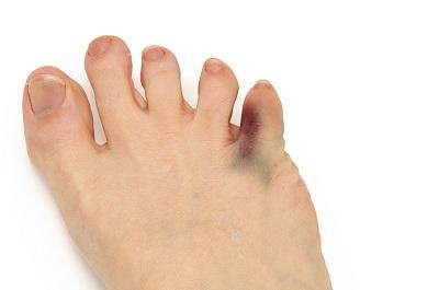 怎么判斷是不是糖尿病足 糖尿病足4大顯著表現