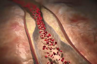 盤點高膽固醇10大忌口 高膽固醇要避免這些行為