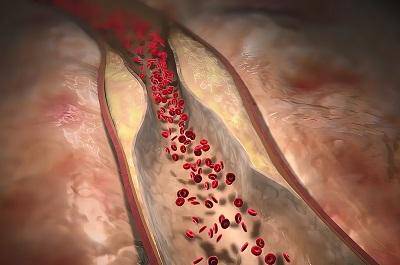 盤點高膽固醇10大忌口 高膽固醇要避免這些行為