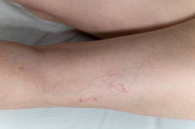 腿血栓的最佳治療方法 盤點溶栓最強十大中藥-易網健康<a href=http://www.aoa7937.com/jkys/ target=_blank class=infotextkey>養生</a>網 腿血栓的最佳治療方法 盤點溶栓最強十大中藥