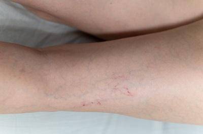 腿血栓的最佳治療方法 盤點溶栓最強十大中藥