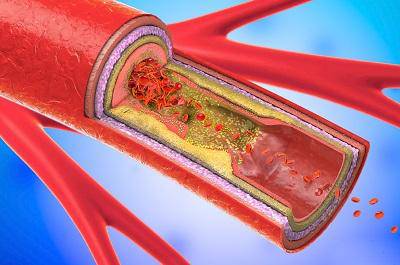 動脈硬化的早期征兆 這四大情況預示動脈硬化