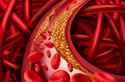 盤點(diǎn)血管斑塊早期10個(gè)征兆 血管斑塊會自己消失嗎-易網(wǎng)健康<a href=http://www.aoa7937.com/jkys/ target=_blank class=infotextkey>養(yǎng)生</a>網(wǎng) 盤點(diǎn)血管斑塊早期10個(gè)征兆 血管斑塊會自己消失嗎