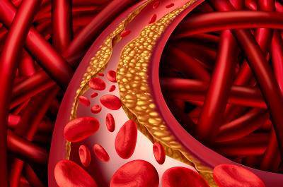 盤點血管斑塊早期10個征兆 血管斑塊會自己消失嗎