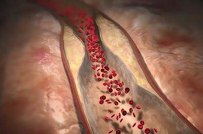 盤點(diǎn)血脂高早期10個(gè)征兆 血脂高早期食療的方法