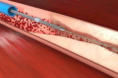 盤點血管堵了十大常見征兆 揭秘血管堵了最佳治療方法