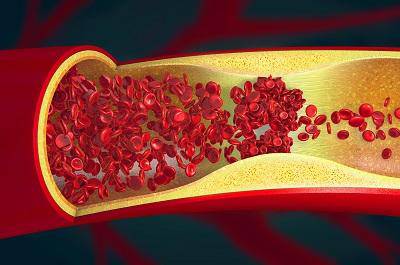 壓差大于60要警惕四種病 壓差大于60最佳治療方法