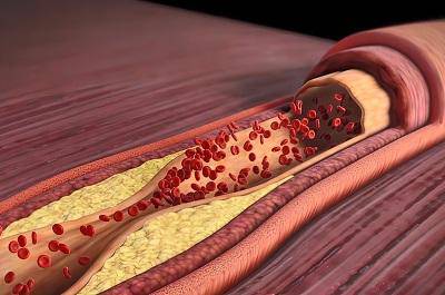 高血脂癥狀表現有哪些 高脂血癥有三個征兆