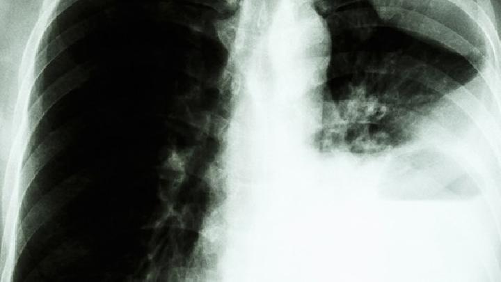 肺癌患者可以過性生活嗎？你知道為什么肺癌不傳染嗎？