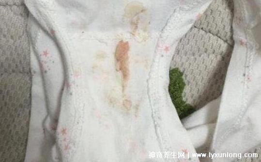 宮頸癌褐色分泌物圖片，少量不規則出血伴隨X交痛(腥臭分泌物)