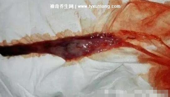 真實女生內膜破壞的圖片，剝脫的子宮內膜伴隨經血排出