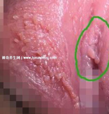 女性假疣和真疣的圖片對(duì)比，前者淡紅色和淡褐色魚子狀(5大區(qū)別)