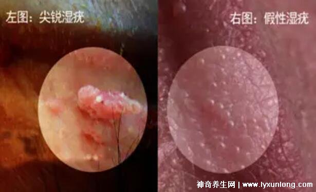 女性假疣和真疣的圖片對(duì)比，前者淡紅色和淡褐色魚子狀(5大區(qū)別)