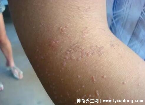 男性疣是什么樣子圖片，尖銳濕疣/扁平疣/絲狀疣發(fā)病部位不同