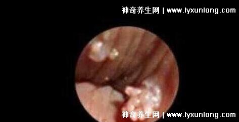 初期尖銳濕尤圖癥狀圖片男性，淡紅色小疙瘩變大為菜花狀疣體