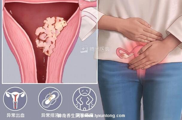 真實宮頸癌的早期出血圖片，接觸性出血是最明顯癥狀(女性必看)