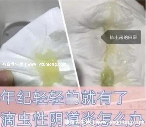 用了甲硝唑后里面長滿了霉菌，破壞有益菌群/衛生不佳(附治療法)