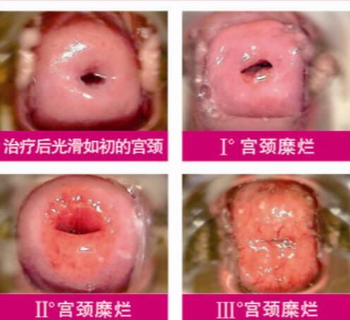 宮頸糜爛一二三度圖片，真實對比照片(小心是宮頸癌前兆)