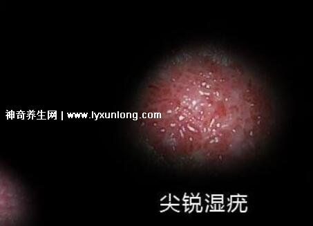 女性假疣和真疣的圖片對(duì)比，前者淡紅色和淡褐色魚子狀(5大區(qū)別)