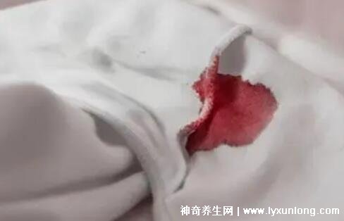 宮頸癌褐色分泌物圖片，少量不規則出血伴隨X交痛(腥臭分泌物)