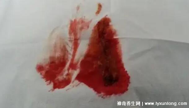 宮頸癌褐色分泌物圖片，少量不規則出血伴隨X交痛(腥臭分泌物)