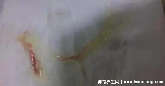 宮頸癌褐色分泌物圖片，少量不規則出血伴隨X交痛(腥臭分泌物)