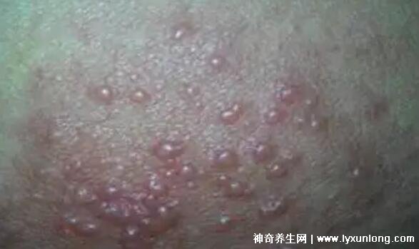 男性疣是什么樣子圖片，尖銳濕疣/扁平疣/絲狀疣發(fā)病部位不同