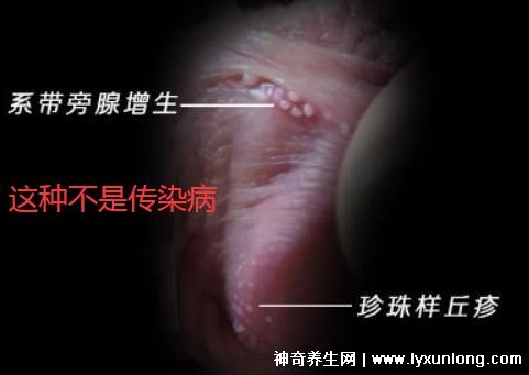 初期尖銳濕尤圖癥狀圖片男性，淡紅色小疙瘩變大為菜花狀疣體