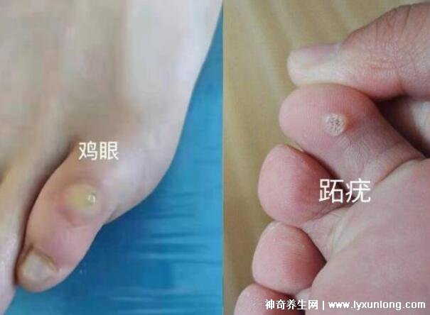 男性疣是什么樣子圖片，尖銳濕疣/扁平疣/絲狀疣發(fā)病部位不同