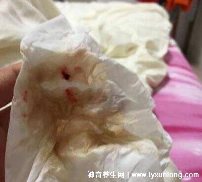 宮頸癌褐色分泌物圖片，少量不規則出血伴隨X交痛(腥臭分泌物)