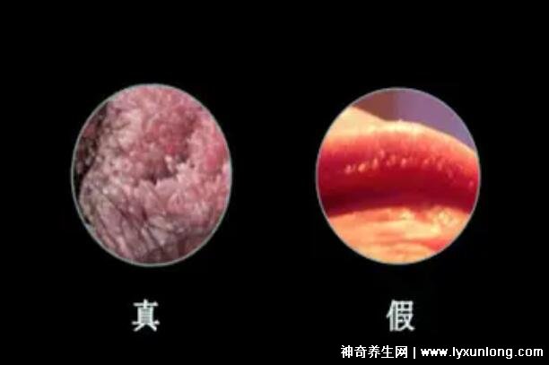 女性假疣和真疣的圖片對(duì)比，前者淡紅色和淡褐色魚子狀(5大區(qū)別)