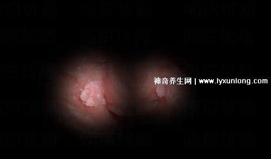 初期女士濕銳疣圖片早期，口腔尖銳濕癥狀太嚇人了(菜花樣疣體)