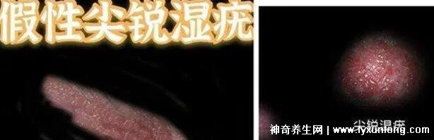 女性假疣和真疣的圖片對(duì)比，前者淡紅色和淡褐色魚子狀(5大區(qū)別)