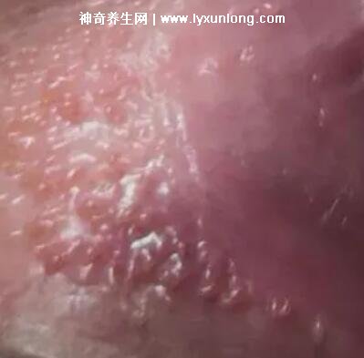 女性假疣和真疣的圖片對(duì)比，前者淡紅色和淡褐色魚子狀(5大區(qū)別)