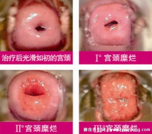 宮頸癌褐色分泌物圖片，少量不規則出血伴隨X交痛(腥臭分泌物)