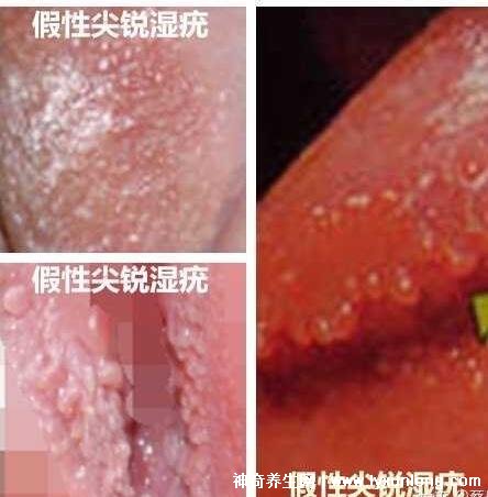 女性假疣和真疣的圖片對(duì)比，前者淡紅色和淡褐色魚子狀(5大區(qū)別)