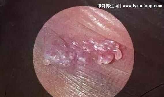 初期尖銳濕尤圖癥狀圖片男性，淡紅色小疙瘩變大為菜花狀疣體