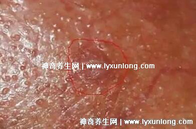 男性早期圖片尖濕銳疣長在哪，生zhi器甚至是口腔(菜花狀疣體出血)
