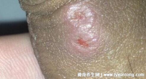 初期尖銳濕尤圖癥狀圖片男性，淡紅色小疙瘩變大為菜花狀疣體