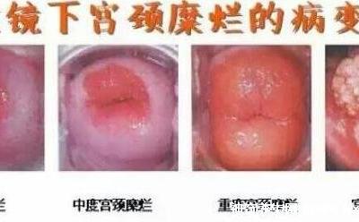 宮頸糜爛一二三度圖片，真實對比照片(小心是宮頸癌前兆)