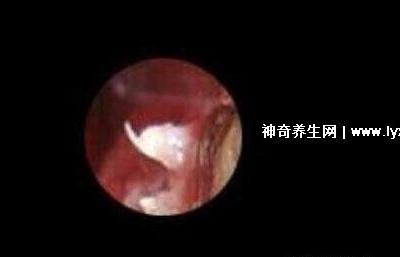 初期女士濕銳疣圖片早期，口腔尖銳濕癥狀太嚇人了(菜花樣疣體)