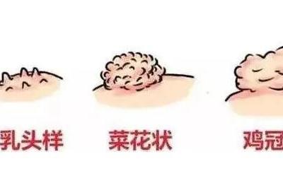 初期尖銳濕尤圖癥狀圖片男性，淡紅色小疙瘩變大為菜花狀疣體