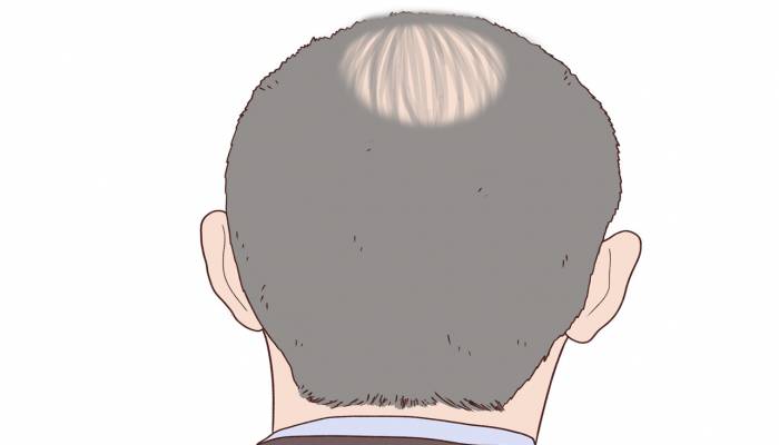 睪酮素升高與脫發(fā)的關(guān)系 如何應(yīng)對(duì)睪酮素升高引起的脫發(fā)