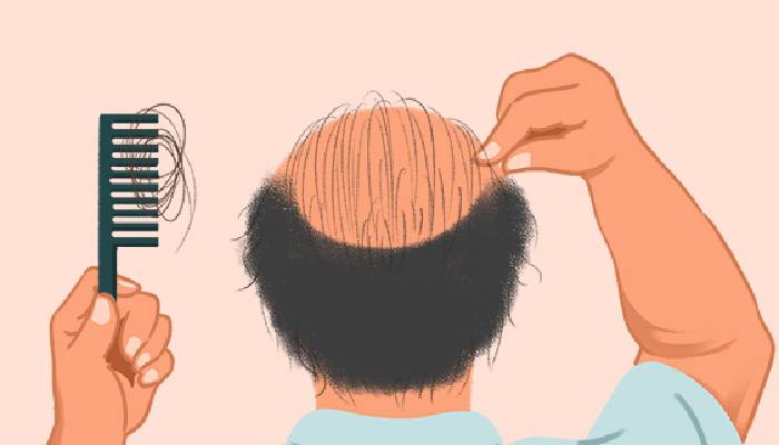 脂溢性脫發的原因是什么 脂溢性脫發有效的防治措施-易網健康<a href=http://www.aoa7937.com/jkys/ target=_blank class=infotextkey>養生</a>網 脂溢性脫發的原因是什么 脂溢性脫發有效的防治措施