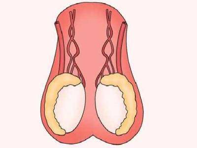 睪丸炎的病因 睪丸炎吃什么藥好