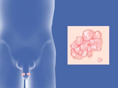 不同尖銳濕疣如何治療 尖銳濕疣治療方法