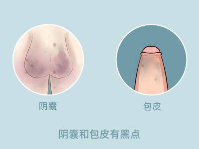 龜頭脫皮怎么回事?警惕炎癥或性病!