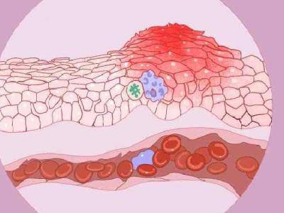生活中警惕男人初犯膀胱炎，膀胱炎的早期發(fā)現(xiàn)可注意以下癥狀